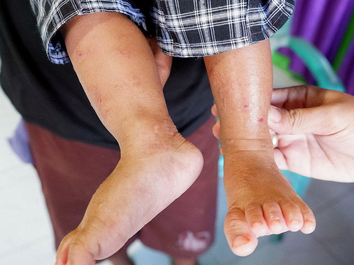 Abyan’s skin is red and itchy. The nine-month-old baby boy has suffered from the skin disease for around four months since the water his family used was allegedly contaminated with mud from nickel mining. Photo: Yuli Z./Project Multatuli