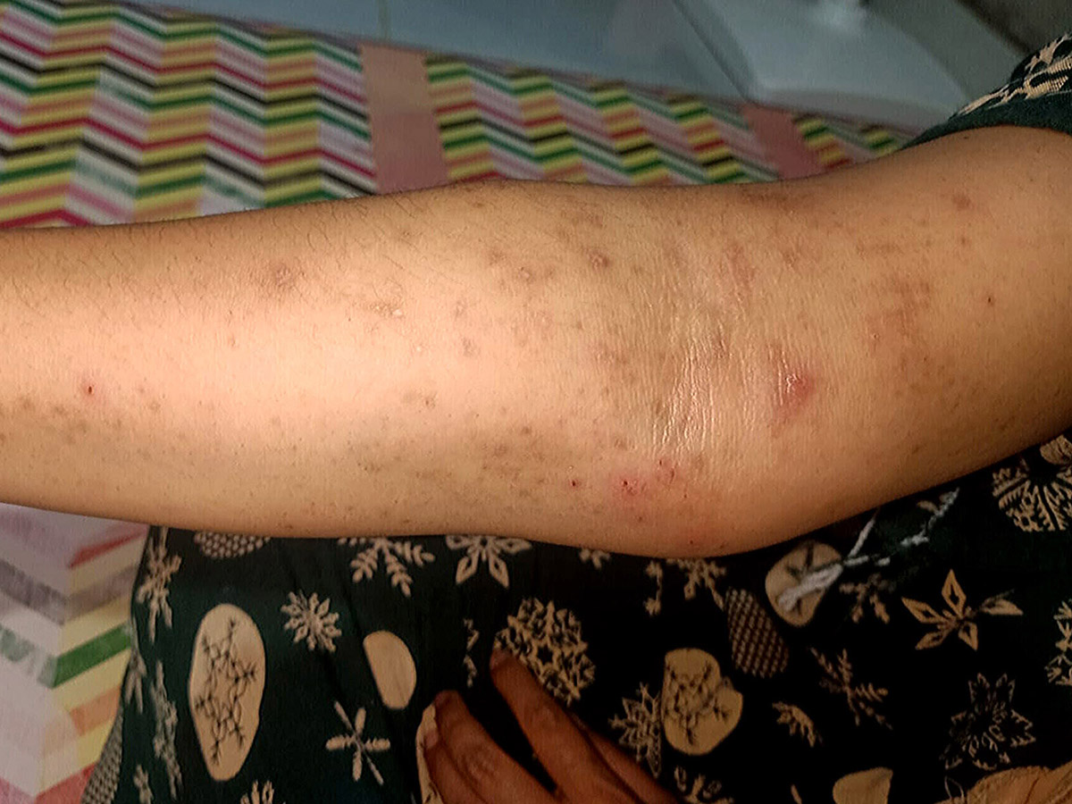 A Sinaulu Jaya resident shows her skin rash. Photo: Yuli Z./Project Multatuli