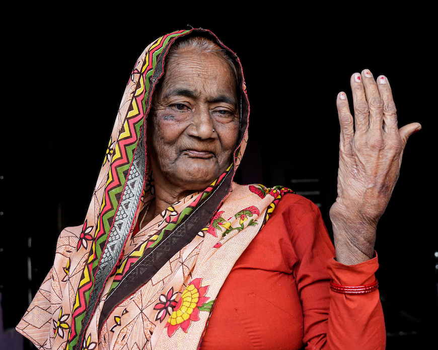 Close-up photo of Sarla, a 60-year-old Uncha Amirpur resident battling Hepatitis C, asthma, kidney diseases and severe bone disease. Photo: Suhail Bhat