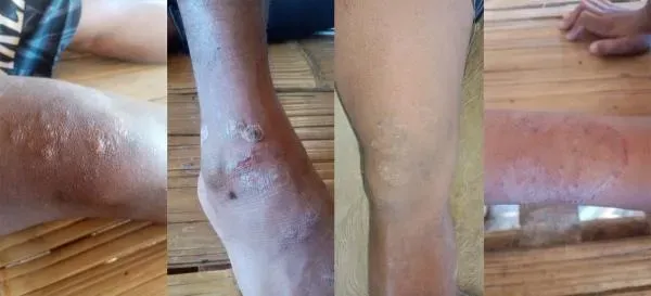 Skin lesions experienced by villagers after contact with river water. Photos: Azneal Ishak, S Vinothaa and Kampung Kelaik villagers