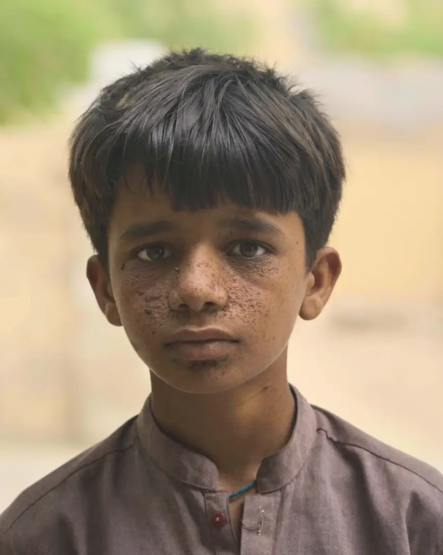 A young boy in a grey kurta with pigmentation and mole clusters on his face showing portraits of Tharparkar,Pakistan residents fallen ill due to the impacts of coal development. Photo: Usama Irfan/Earthwise